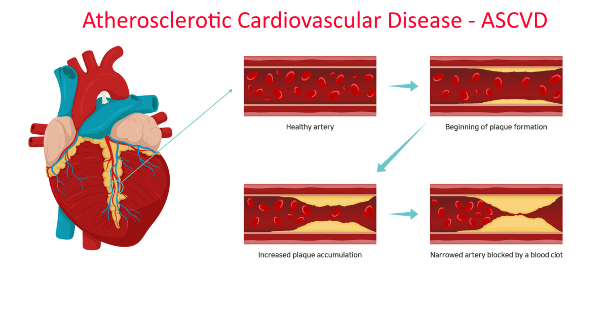 Quá trình hình thành xơ vữa động mạch ASCVD