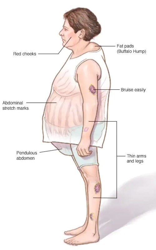 Các triệu chứng của hội chứng Cushing do thuốc: nguyên nhân dây bệnh tiểu đường đặc biệt