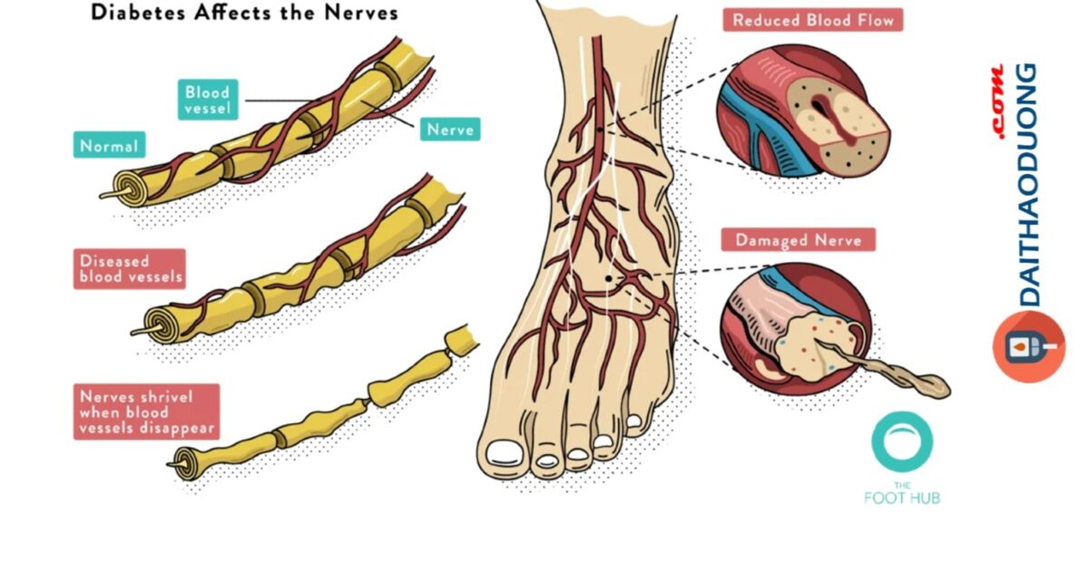 Bệnh tiểu đường ảnh hưởng dây thần kinh bàn chân.