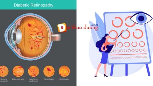Bệnh võng mạc tiểu đường là biến chứng ở mắt do tăng đường huyết