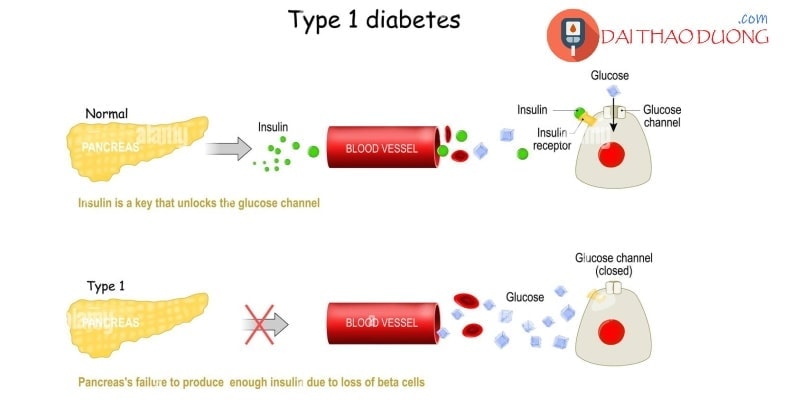Tuyến tụy không sản xuất insulin trong tiểu đường type 1