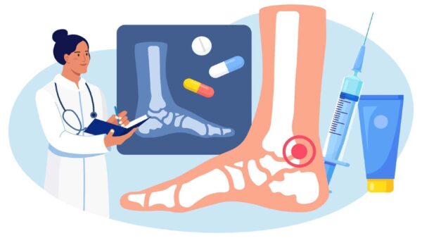 Guideline IWGDF hướng dẫn chăm sóc bàn chân tiểu đường
