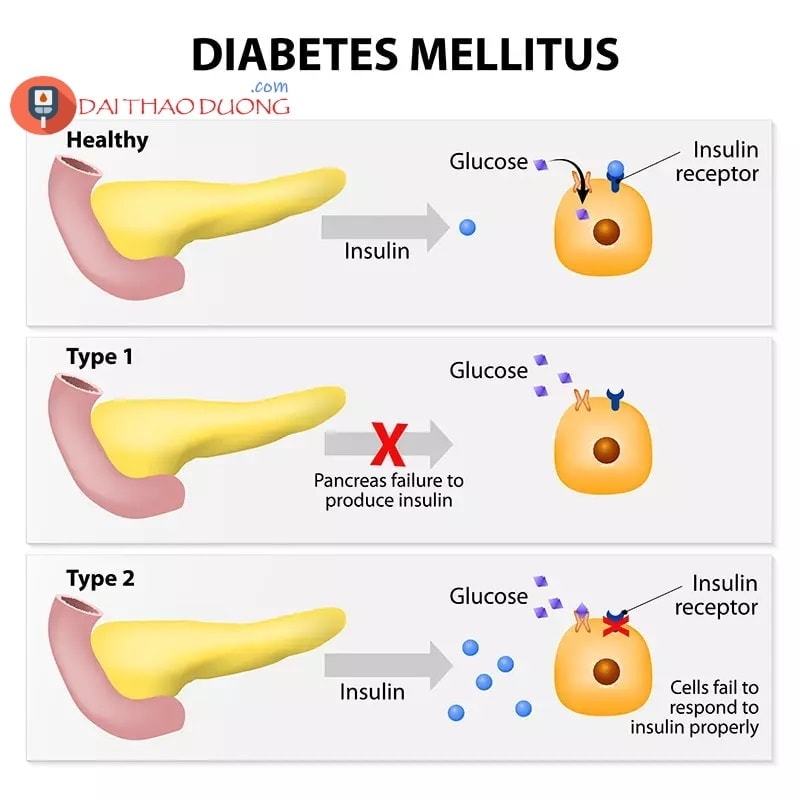 Insulin hoạt động như thế nào trong các type tiểu đường, đái tháo đường