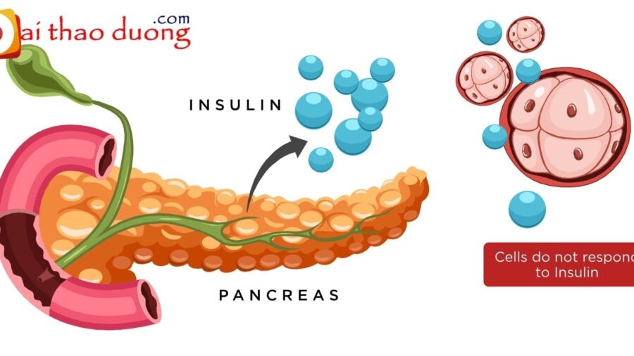 Tế bào không phản hồi insulin từ tuyến tụy