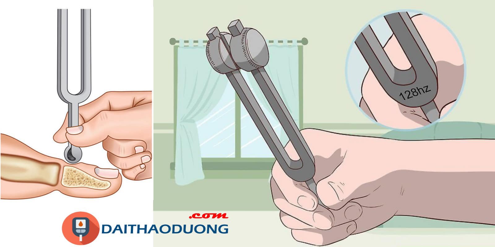 Khám Cảm Giác Rung Để Phát Hiện Biến Chứng Thần Kinh