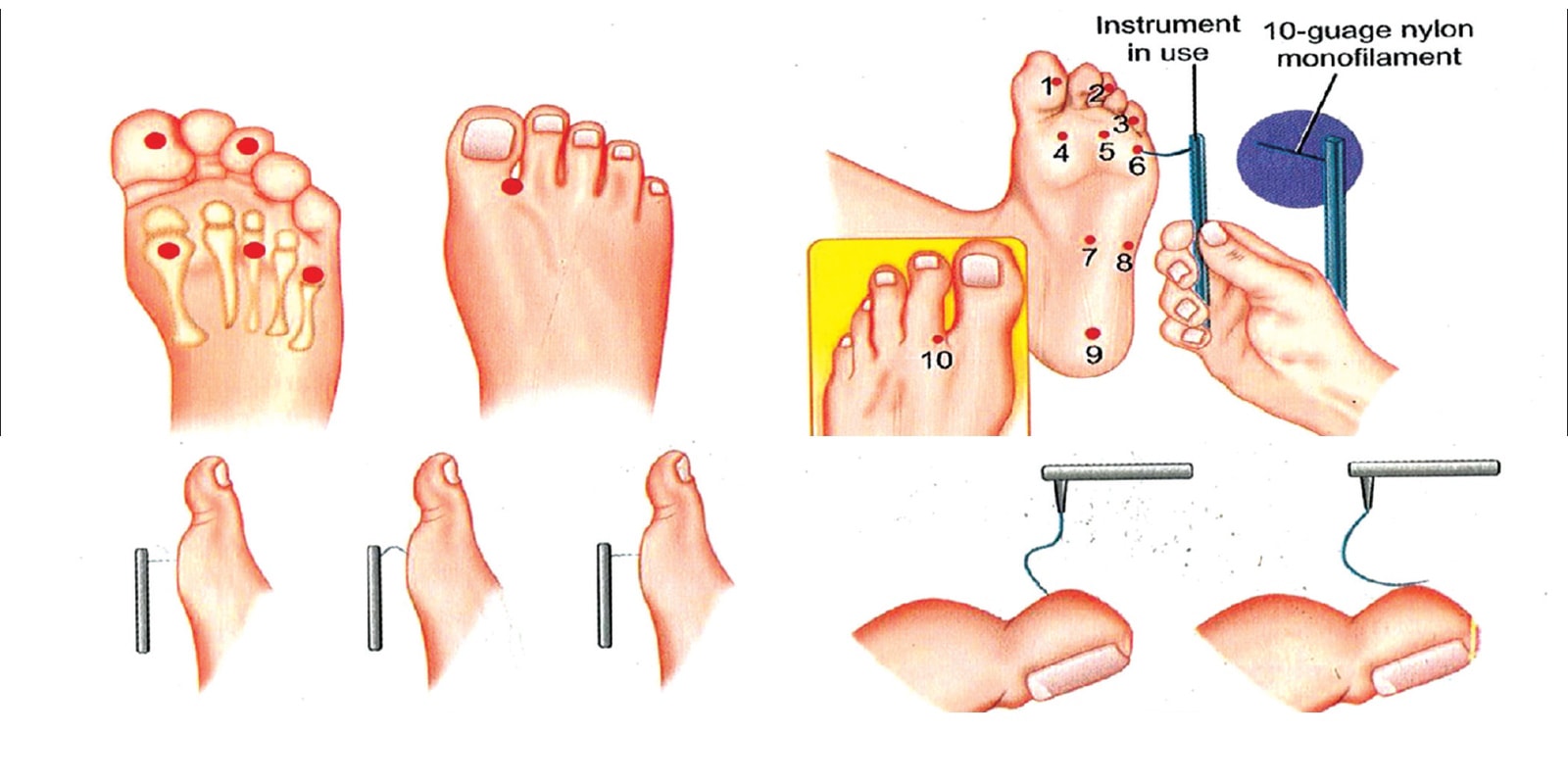 Hướng dẫn cách khám monofilament